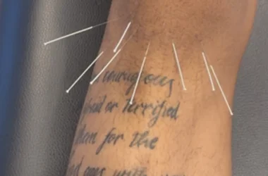 Chiropractic-Upper-Marlboro-MD-Dry-Needling-Knee